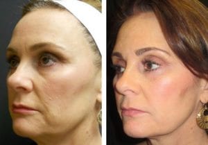 5318-Side-ultherapy-lift - Ultherapy Lift - Before And After | Fairfax and Manassas VA