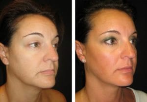 551-Side-ultherapy-lift - Ultherapy Lift - Before And After | Fairfax and Manassas VA