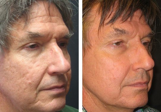 5806-fractional-co2-laser-treatment - Fractional CO2 Laser - Before And After | Fairfax and Manassas VA
