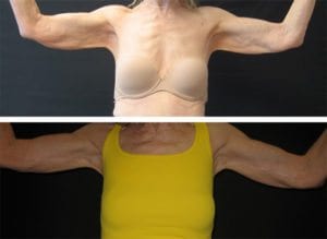 Arm Lifts - Before And After - Fairfax and Manassas VA