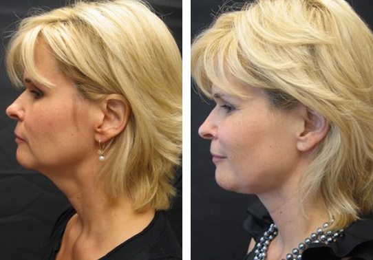 5902-dvd-necklift - Neck Lift - Before And After | Fairfax and Manassas VA