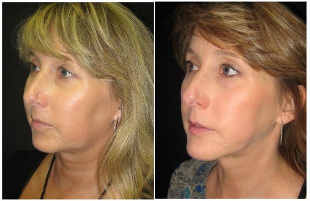 6012a56170b1fd21c6-neck-liposuction - Neck Liposuction - Before And After | Fairfax and Manassas VA