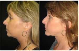 6012b56170b207d066-neck-liposuction - Neck Liposuction - Before And After | Fairfax and Manassas VA