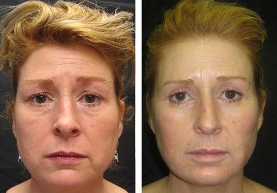6162-front-view527114ecddd2c-non-surgical-facelift - Non-Surgical Facelift - Patient 2 - Before & After 2 | Fairfax and Manassas, VA