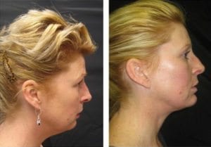 6162-sideview527114ec00238-non-surgical-facelift - Non-Surgical Facelift - Patient 2 - Before & After 1 | Fairfax and Manassas, VA