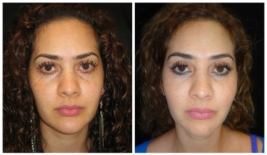 6490a-fat-grafting - Fat Grafting - Before And After - Fairfax and Manassas VA