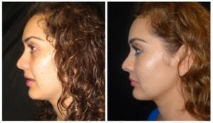 6490c-fat-grafting - Fat Grafting - Before And After - Fairfax and Manassas VA