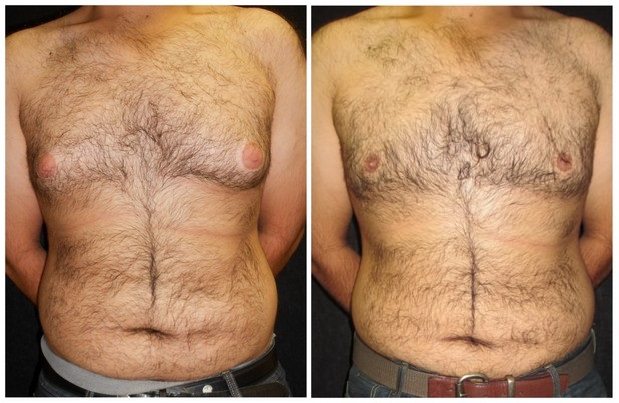 6826a-male-breast-reduction - Male Breast Reduction - Before And After - Gynecomastia - Fairfax and Manassas VA