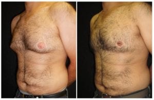 6826b-male-breast-reduction - Male Breast Reduction - Before And After - Gynecomastia - Fairfax and Manassas VA