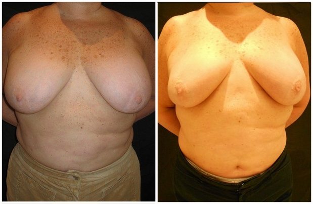 6986a-breast-reduction-liposuction - Breast Reduction Liposuction - Before And After - Fairfax and Manassas VA