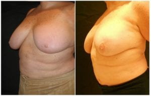6986b-breast-reduction-liposuction - Breast Reduction Liposuction - Before And After - Fairfax and Manassas VA