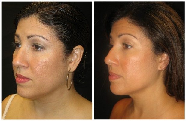 7083a-neck-liposuction - Neck Liposuction - Before And After | Fairfax and Manassas VA