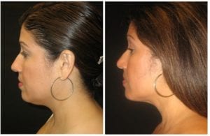 Neck Liposuction - Before And After | Fairfax and Manassas VA