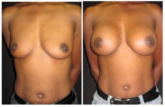 7846a-breast-augmentation - Breast Augmentation Before And After - Fairfax and Manassas VA