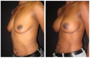 7846b-breast-augmentation - Breast Augmentation - Patient 35 - Before & After 2 | Fairfax and Manassas, VA