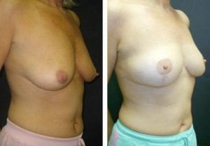 7854-side-breast-lift - Breast Lift - Mastopexy Before And After - Fairfax and Manassas VA