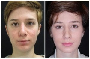8120a52e662451ddcb-rhinoplasty-for-women - Rhinoplasty For Women - Before And After | Fairfax and Manassas VA
