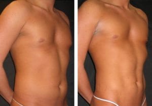8149-45-degree-angle-abdominal-etching - Abdominal Etching - Before And After - Fairfax and Manassas VA