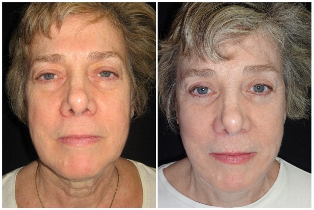 8281a-facelift - Facelift - Before And After Photos - Fairfax and Manassas VA