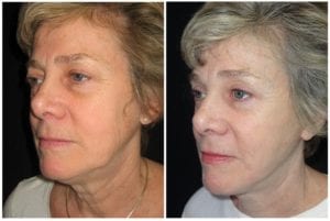 8281b-facelift - Facelift - Before And After Photos - Fairfax and Manassas VA