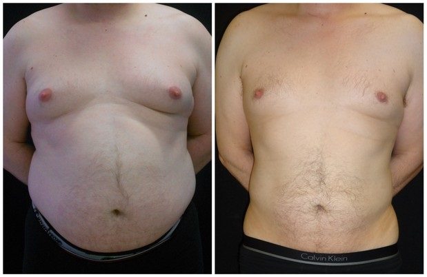 8393a54498129806dc-liposuction - Liposuction - Before And After - Fairfax and Manassas VA