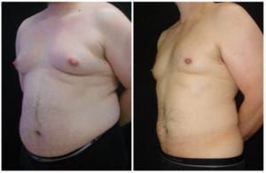 8393b5449812b13946-liposuction - Liposuction - Before And After - Fairfax and Manassas VA