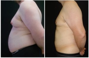 8393c5449812c93ae5-liposuction - Liposuction - Before And After - Fairfax and Manassas VA