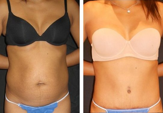 8475-front-tummy-tuck-abdominoplasty - Tummy Tuck & Abdominoplasty - Before And After - Fairfax and Manassas VA