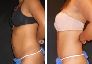 8475-side-tummy-tuck-abdominoplasty - Tummy Tuck & Abdominoplasty - Before And After - Fairfax and Manassas VA