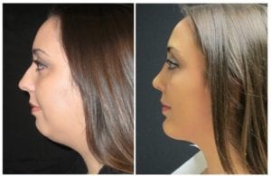 8555b-chin-implant - Chin Implant Before And After - Fairfax and Manassas VA