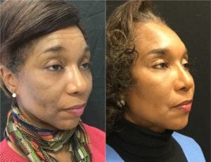Non-Surgical Facelift - Before And After | Fairfax and Manassas VA