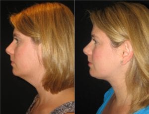 8791-20170323_Canvas-necklift - Neck Lift - Before And After | Fairfax and Manassas VA