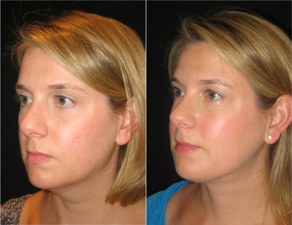 8791-20170323_Oblique-necklift - Neck Lift - Before And After | Fairfax and Manassas VA
