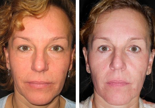 8796-lower-eyelid-lifts-lower - Lower Eyelid Lift - Before And After - Fairfax and Manassas VA