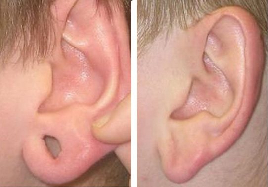 9-torn-earlobe-repair - Torn Earlobe Repair - Before And After | Fairfax and Manassas VA
