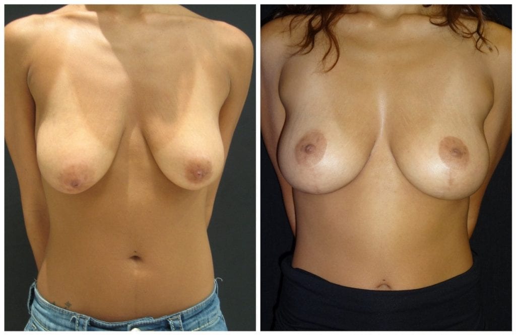 9003a-breast-lift - Breast Lift - Mastopexy Before And After - Fairfax and Manassas VA