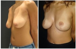 9003b-breast-lift - Breast Lift - Mastopexy Before And After - Fairfax and Manassas VA