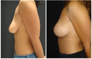 9003c-breast-lift - Breast Lift - Mastopexy Before And After - Fairfax and Manassas VA