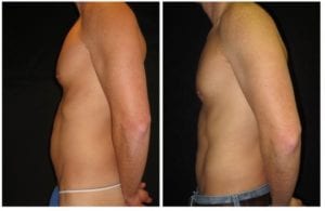 Laser Lipo - Before And After - Fairfax and Manassas VA
