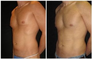 9107b53554f459e2dd-liposuction - Liposuction - Before And After - Fairfax and Manassas VA