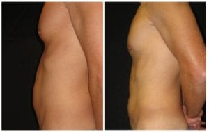 9107c-liposuction - Liposuction - Before And After - Fairfax and Manassas VA