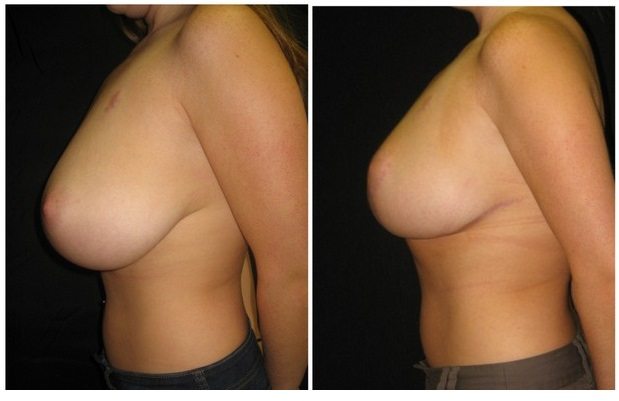 9129b-breast-reduction - Breast Reduction Before And After - Fairfax and Manassas VA