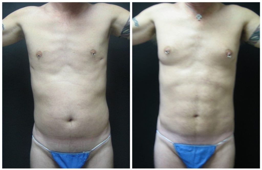 9195a-abdominal-etching - Abdominal Etching - Before And After - Fairfax and Manassas VA