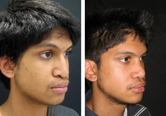9221-front-rhinoplasty-for-men - Rhinoplasty For Men - Before And After | Fairfax and Manassas VA