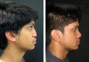 9221-side-rhinoplasty-for-men - Rhinoplasty For Men - Before And After | Fairfax and Manassas VA