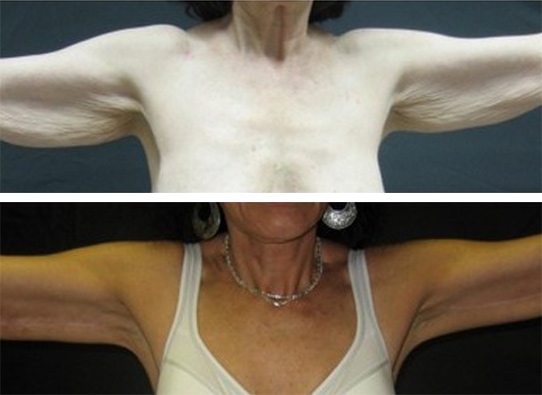 9277-armlift-arm-lifts - Arm Lifts - Before And After - Fairfax and Manassas VA