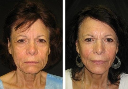 9277-faceliftfront-facelift - Facelift - Before And After Photos - Fairfax and Manassas VA