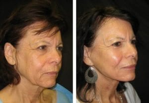 9277-faceliftside-facelift - Facelift - Before And After Photos - Fairfax and Manassas VA