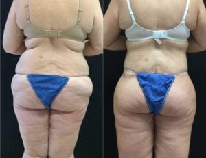 9296-20170605_Butt-lift-Canvas-lower-body-lift - Lower Body Lift - Before And After - Fairfax and Manassas VA