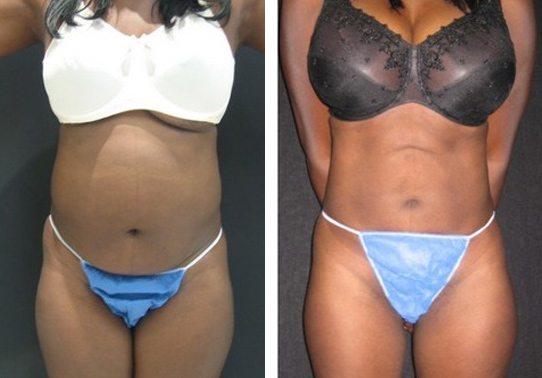 9324a-liposuction - Liposuction - Before And After - Fairfax and Manassas VA